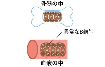 異常なB細胞