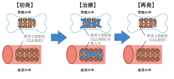 CLLの再発