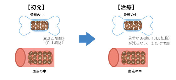 CLLの難治性