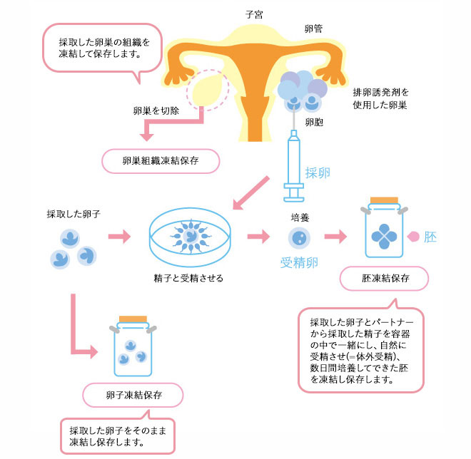 女性の場合の対策：凍結保存