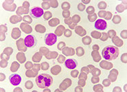 慢性リンパ性白血病（CLL）の病態